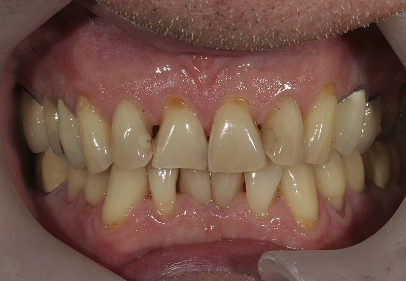Patientenfall 3 Zahnarzt Stuttgart Strohkendl Bild 2