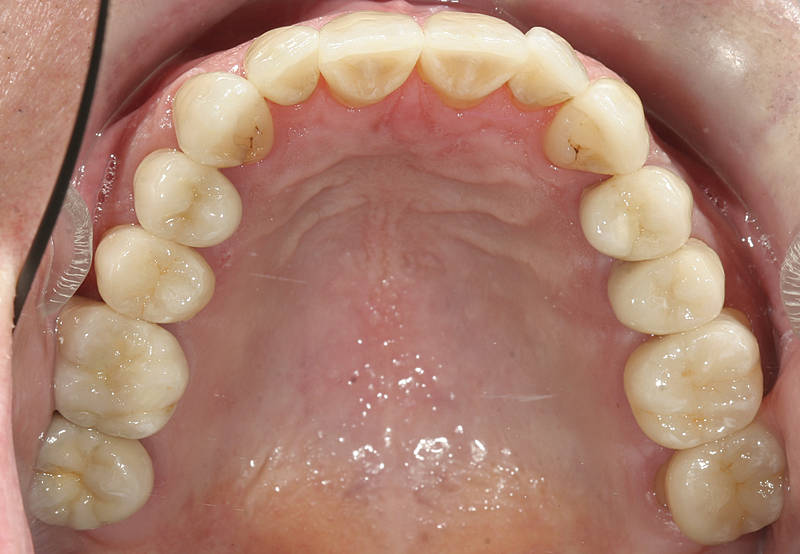 Patientenfall 3 Zahnarzt Stuttgart Strohkendl Bild 15