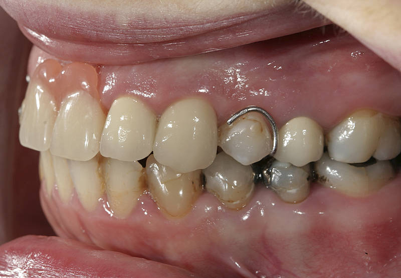 Patientenfall 10 Zahnarzt Stuttgart Strohkendl Bild 8