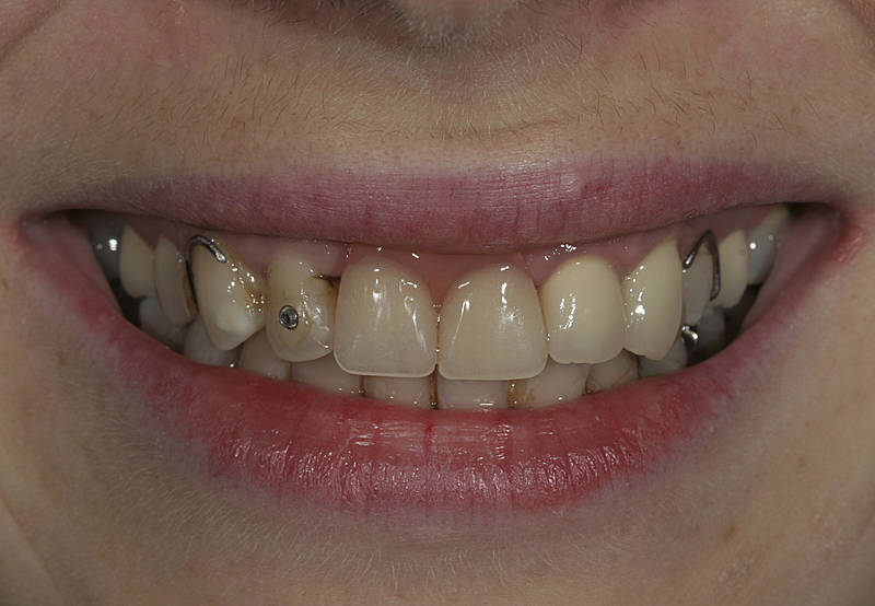 Patientenfall 10 Zahnarzt Stuttgart Strohkendl Bild 1