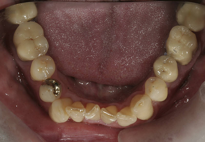 Patientenfall 3 Zahnarzt Stuttgart Strohkendl Bild 8