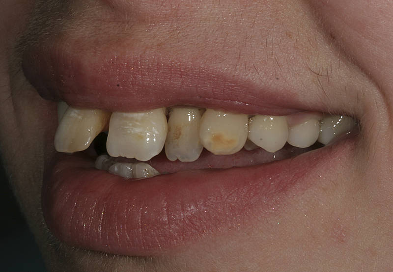 Patientenfall 11 Zahnarzt Stuttgart Strohkendl Bild 6