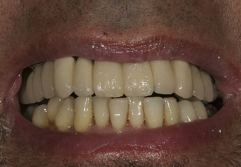 Patientenfall 9 Zahnarzt Stuttgart Strohkendl Bild 1