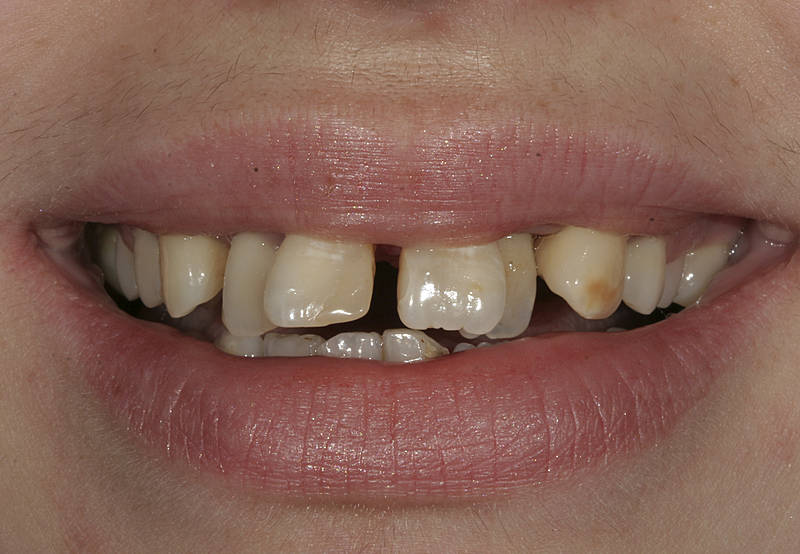 Patientenfall 11 Zahnarzt Stuttgart Strohkendl Bild 2