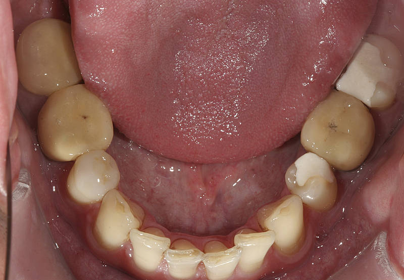 Patientenfall 2 Zahnarzt Stuttgart Strohkendl Bild 3