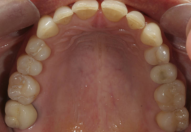 Patientenfall 8 Zahnarzt Stuttgart Strohkendl Bild 8