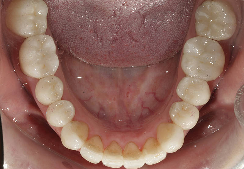 Patientenfall 10 Zahnarzt Stuttgart Strohkendl Bild 15