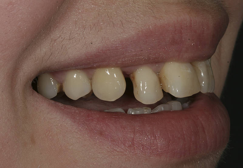 Patientenfall 11 Zahnarzt Stuttgart Strohkendl Bild 5