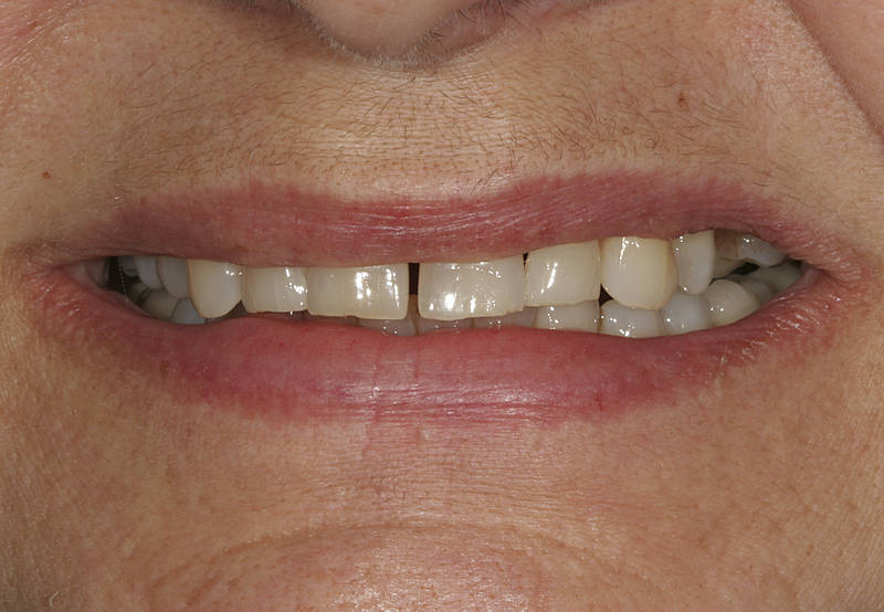 Patientenfall 8 Zahnarzt Stuttgart Strohkendl Bild 1